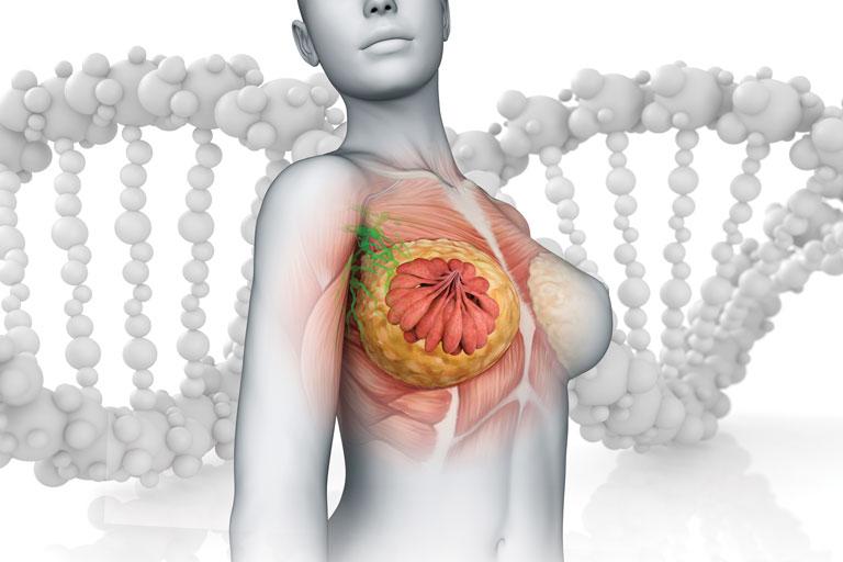 Factores genéticos y su impacto en el riesgo de cáncer de seno