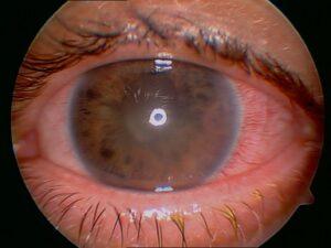 Retinopatía hipertensiva causada por presión arterial alta