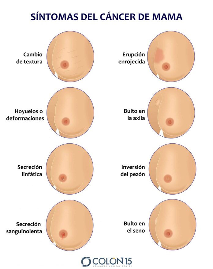 Tres factores que aumentan la probabilidad de padecer cáncer de seno