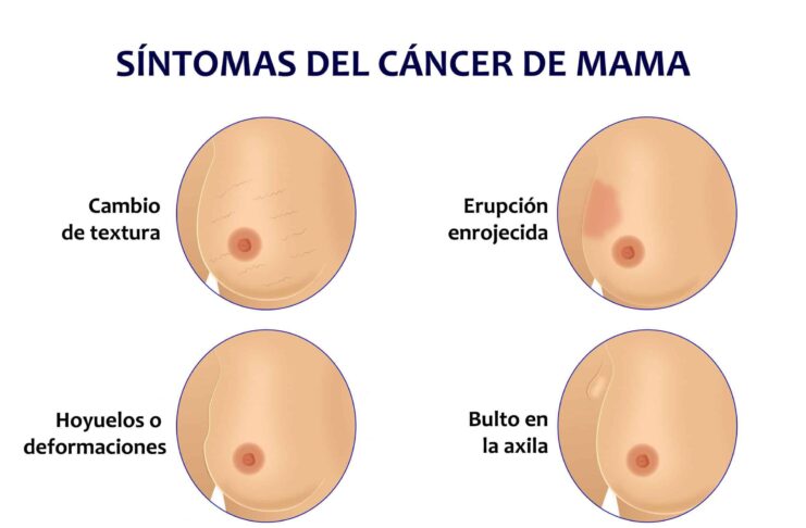 Tres factores que aumentan la probabilidad de padecer cáncer de seno