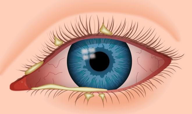Retinopatía diabética causada por diabetes