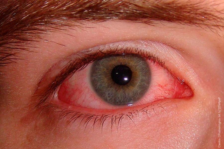 Inflamación ocular por lupus eritematoso sistémico